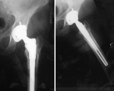 Case example. Image shows successful titanium tota