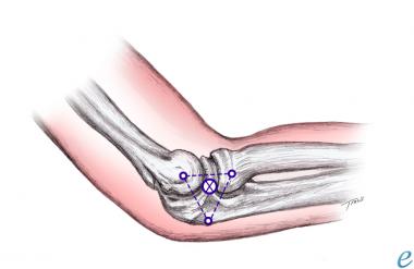 Triangle formed between olecranon, lateral epicond