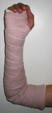 Posterior elbow splint. Image courtesy of Kenneth 