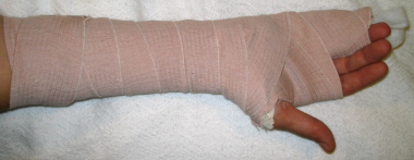 Ulnar gutter splint. Image courtesy of Kenneth R C