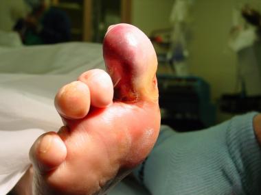 Early wet gangrene of hallux. This began secondary