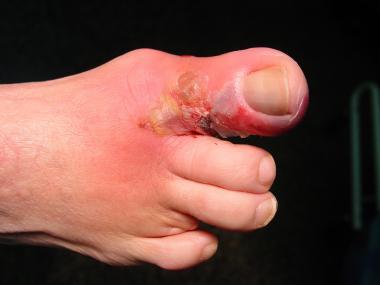 Early wet gangrene of hallux. 