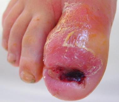 Onychocryptosis in 13-year-old boy that has gone u