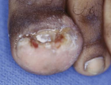 Onychocryptosis with paronychia of medial and late