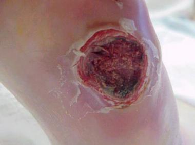 Infected ulceration plantar to fifth metatarsal he