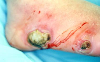 Gangrene with underlying deep-space infection. "Mi