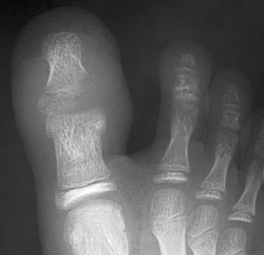 Osteomyelitis of the distal phalanx secondary to u