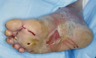 Infected diabetic ulceration prior to debridement.