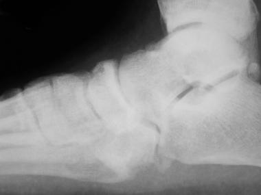 Lateral view of foot demonstrating osteomyelitis. 