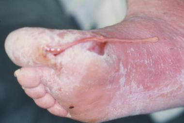 Foot infection with purulent discharge secondary t