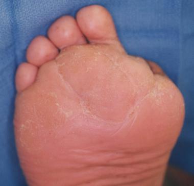 Ulceration on plantar surface of the foot secondar