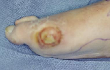 Chronic diabetic ulceration with underlying osteom