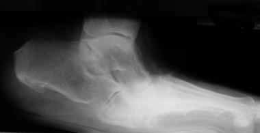 Lateral radiograph of diabetic patient with Charco