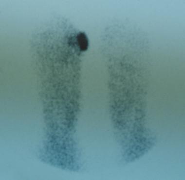 Chronic diabetic ulceration with underlying osteom