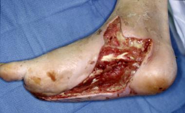 Infected diabetic ulceration. Shown is clean wound