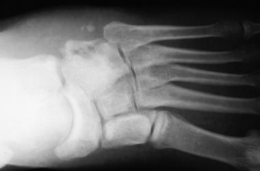 Radiographs of foot demonstrate development of ost