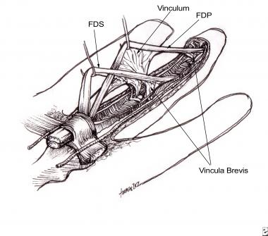 Flexor tendons with attached vincula. 