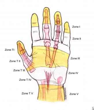 Zones of the hand. Note the relationships to the u