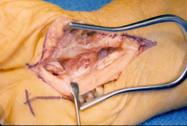 Mannerfelt syndrome. Edges of ruptured flexor poll