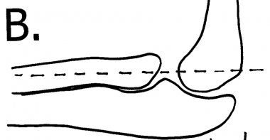 Normal radiocapitellar line drawn from radius thro