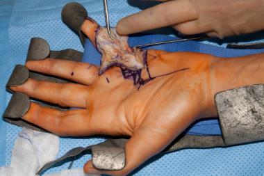 Dissection of spiral cord in the hand of a patient