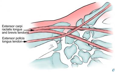 Injection of wrist joint. 