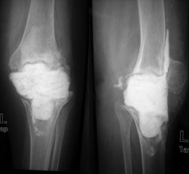 Radiograph after stage I revision. 