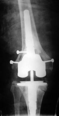 Final radiograph after stage II revision. 