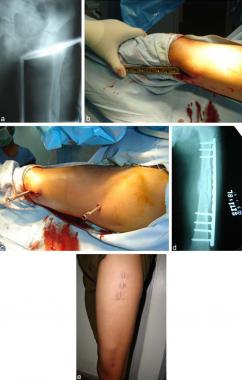 (a) Comminuted fracture shaft of femur in adolesce