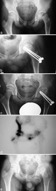 Type II distal femoral epiphyseal injury fixed wit