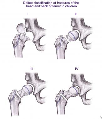 Depiction of various Delbet types of proximal femo