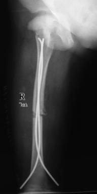 Immediate postoperative x-ray of titanium elastic 