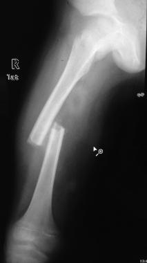 X-ray of adolescent who sustained sporting injury 