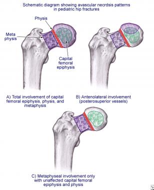 Patterns of avascular necrosis in hip fractures in