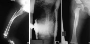 Spiral fracture of femoral shaft, with hypertrophi