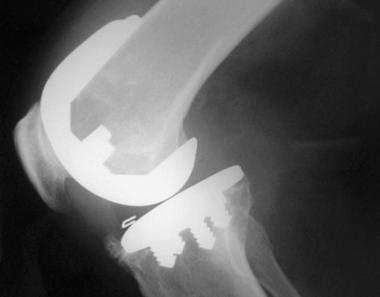 Total knee arthroplasty. Implanted knee with excel