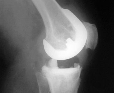 Complications of total knee arthroplasty. Postoper