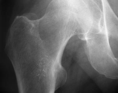 Enchondroma of proximal femur. 