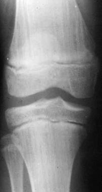 Osteopathia striata. This condition is characteriz