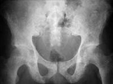 Osteopoikilosis. Plain radiograph of the pelvis sh