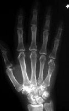 Solitary enchondroma. Frontal radiograph of the ri