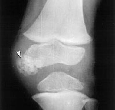 Epiphyseal osteochondroma. Image shows the anterop