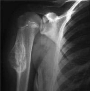 Solitary osteochondroma. Anteroposterior radiograp