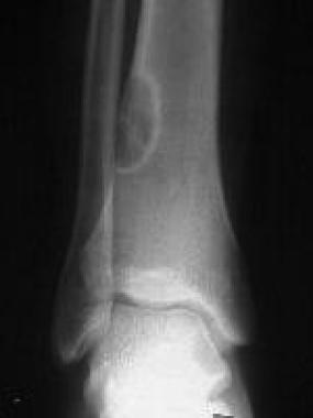 Fibrous cortical defect and nonossifying fibroma. 