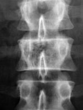 Bone hemangioma. Radiograph depicts the typical co