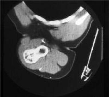 Solitary osteochondroma. CT scan of the sessile os