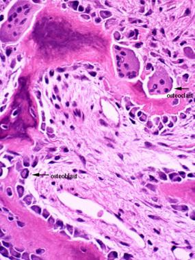 Remodeling of bone. Multiple osteoclasts are sitti