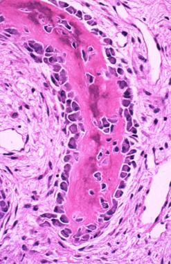 Active osteoblasts depositing osteoid on the surfa