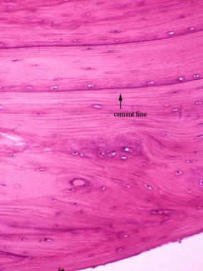 Woven bone under a polarized microscope; collagen 
