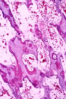 Primary spongiosa in the ossification zone of grow